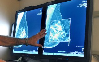 ESY offering free mammograms for women aged 49 and 50