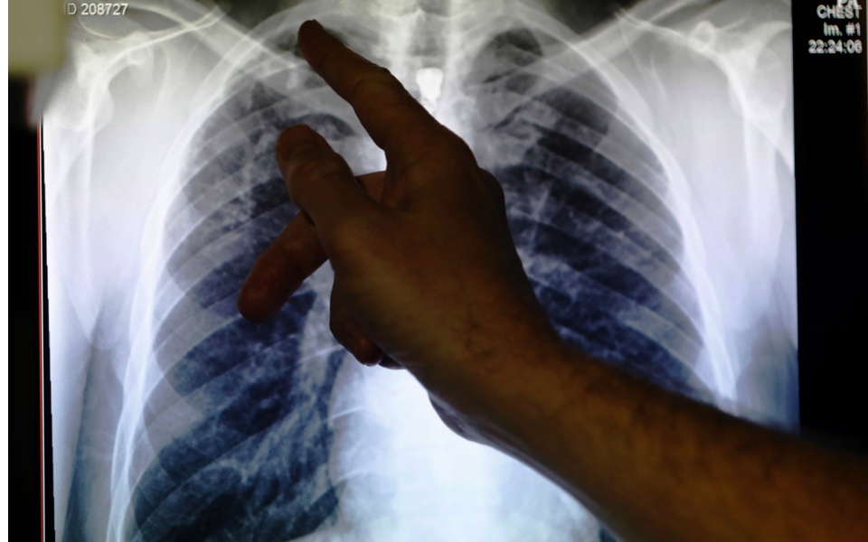 Experts warn tuberculosis may spread in coming years