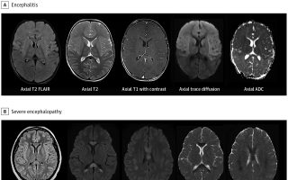 Some children with Covid-related syndrome develop neurological symptoms