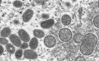 Expert says monkeypox ‘not pandemic’